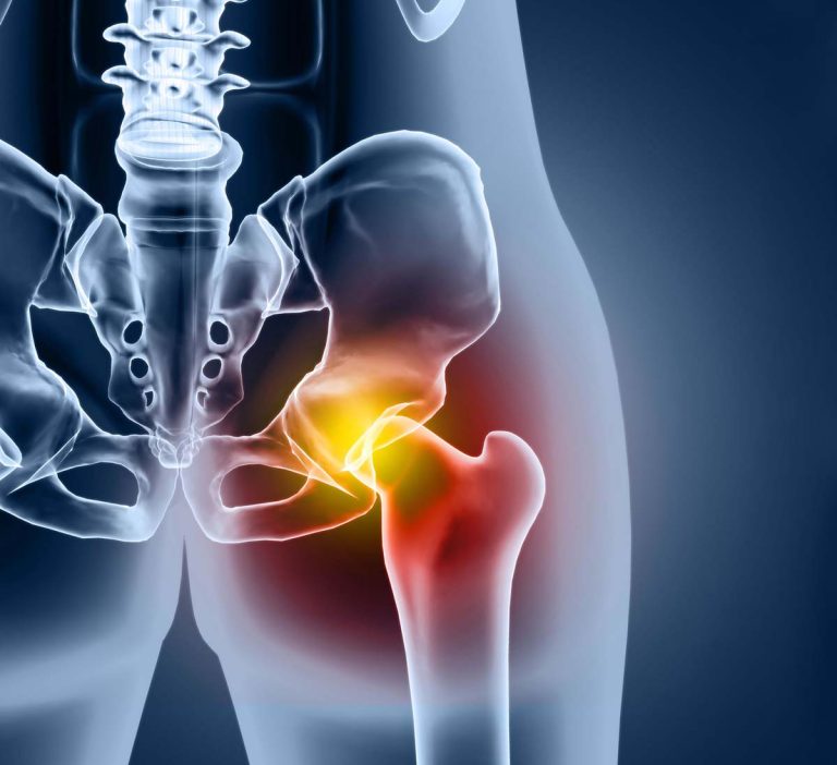 compensation-for-a-severe-hip-injury